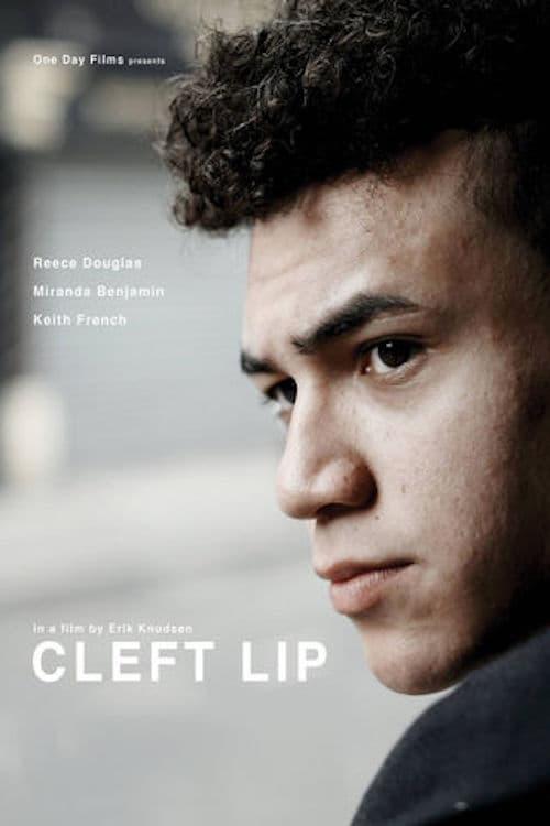 Cleft Lip